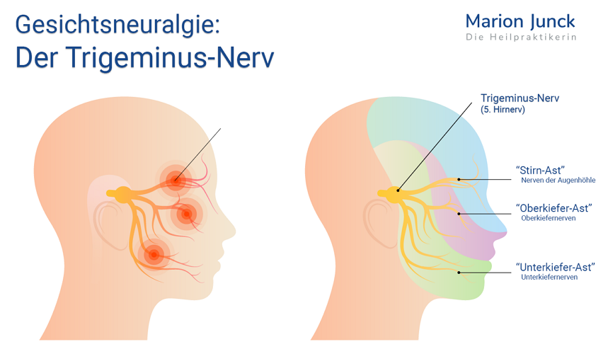 Trigeminusneuralgie Infografik Trigeminusnerv Hirnnerv